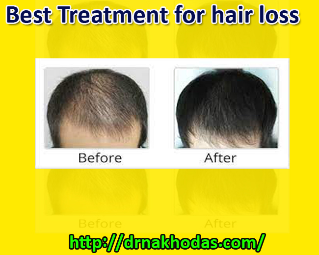 PRP Treatment For Hair And Face – Help You Achieving Healthy Skin & Smooth Hair