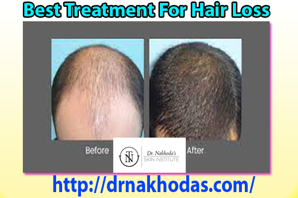 Determining The Best Treatment For Hair Loss