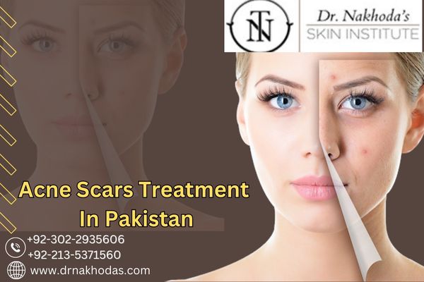 Is Revlite Treatment In Karachi For Acne Scars Right For You? Here’s Everything You Need To Know