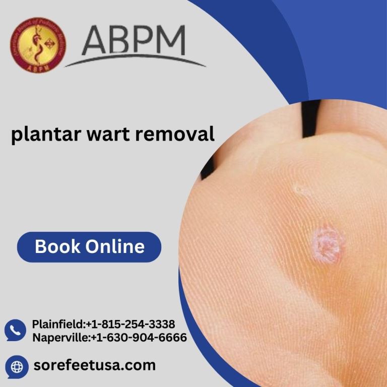 Step-by-Step Guide for Plantar Wart Removal By Expert Foot Doctors In Plainfield